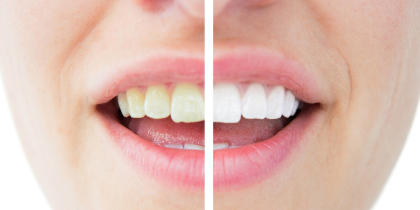 Why Is My Teeth Changing Color?