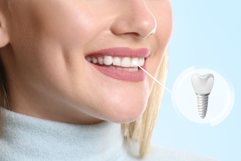 Why No Dairy After Dental Implant? Here’s What To Know