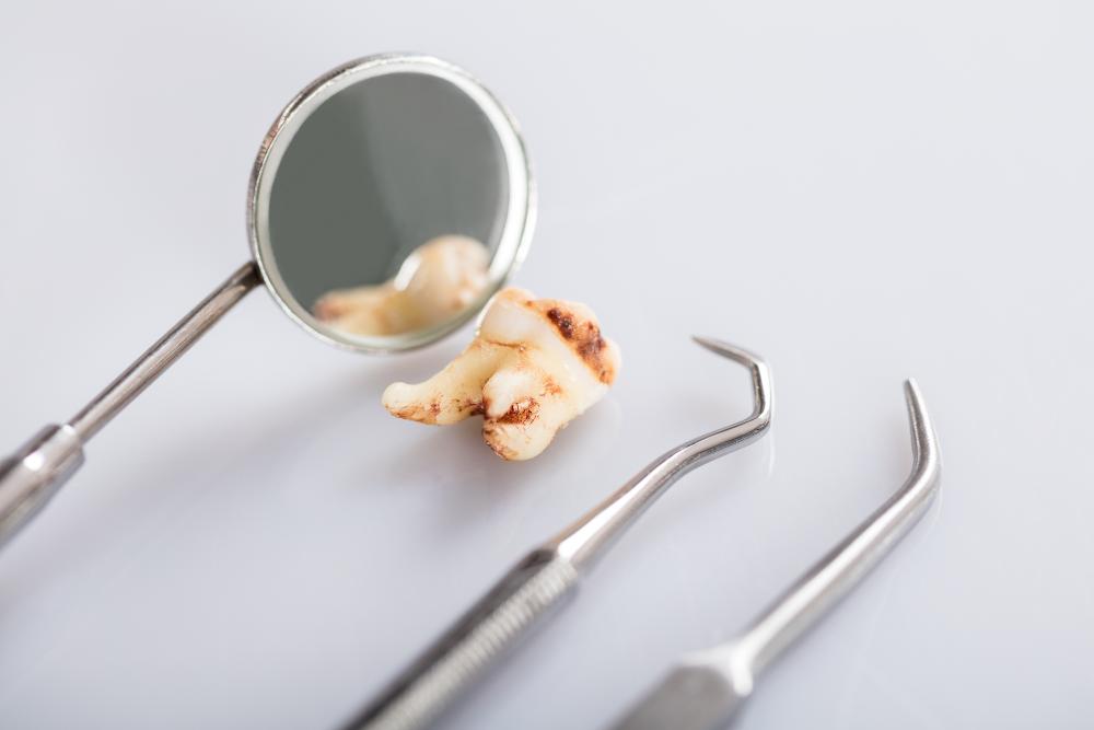 Why You Should Avoid Diary Products After Tooth Extraction