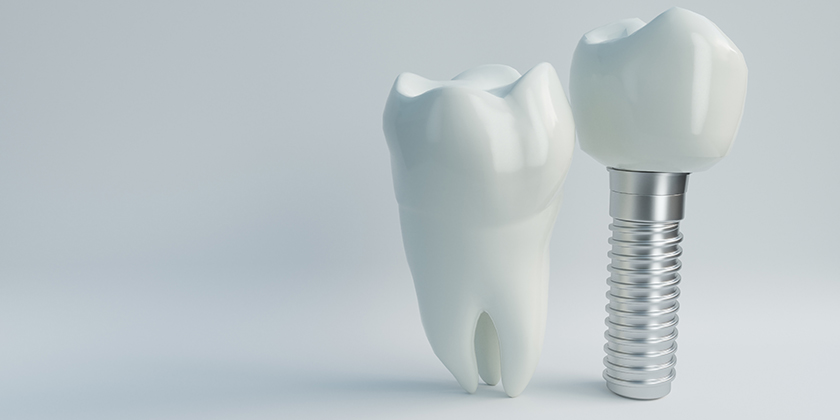 Why Titanium Is Used In Dental Implants