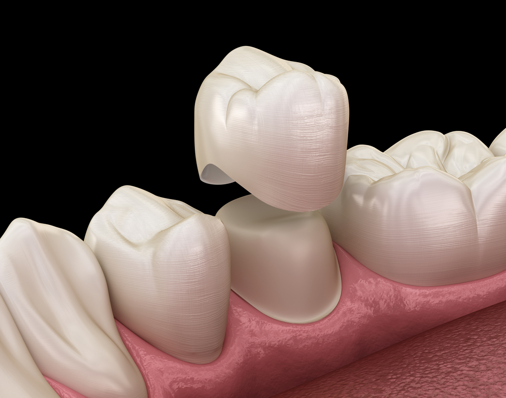 Why You Need A Crown After A Root Canal Treatment