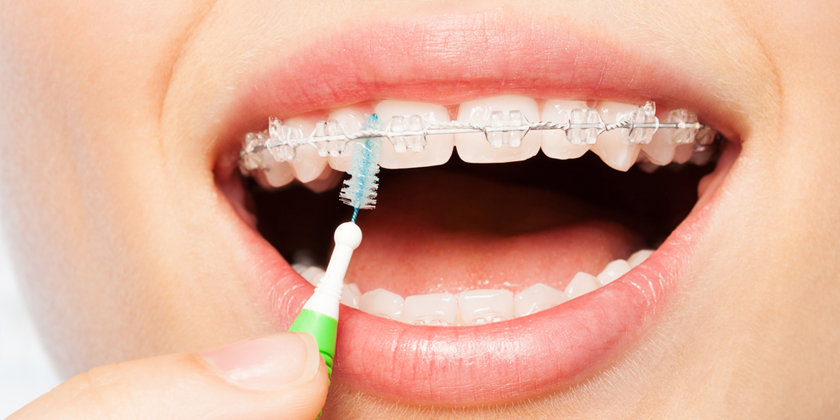 Why You Should Consider Early Orthodontic Treatment