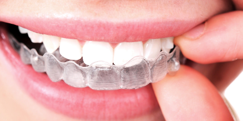 Invisalign