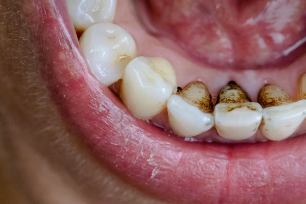 Worried About Coffee Stains On Your Teeth?