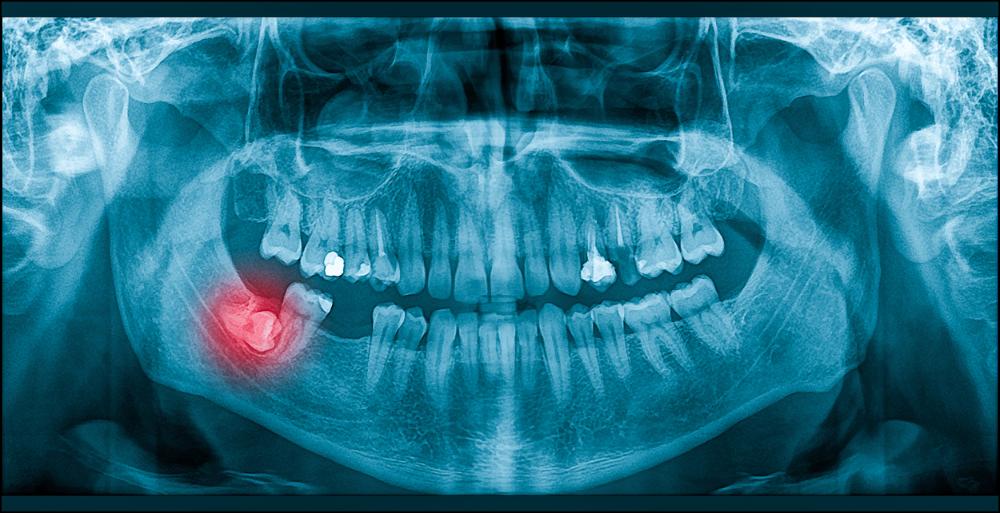 7 Common Types Of Impacted Wisdom Teeth