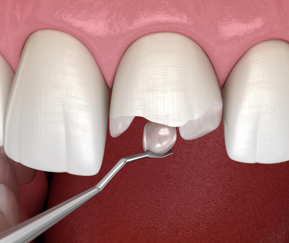 3 Dental Procedures To Repair A Broken Tooth