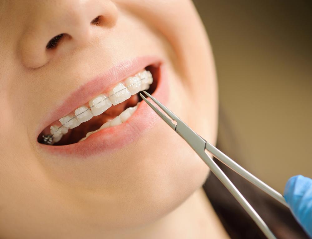 4 Different Types Of Braces: Which One Is Right For You?