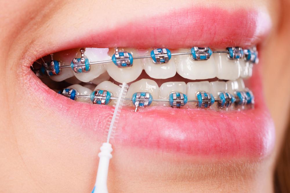 braces aftercare
