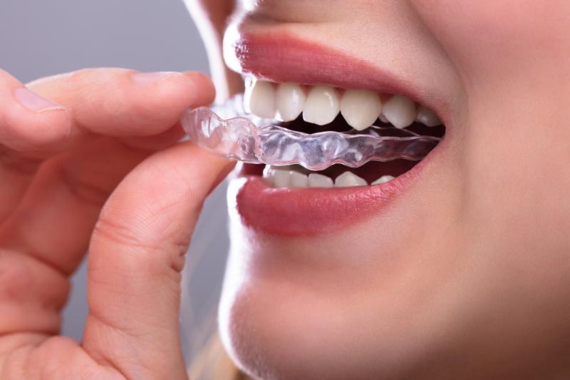 5 Invisalign Alternatives For Perfect Teeth Alignment