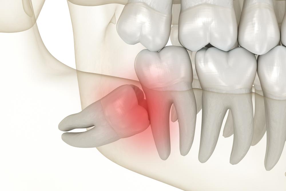5 Most Common Symptoms Of Impacted Wisdom Teeth