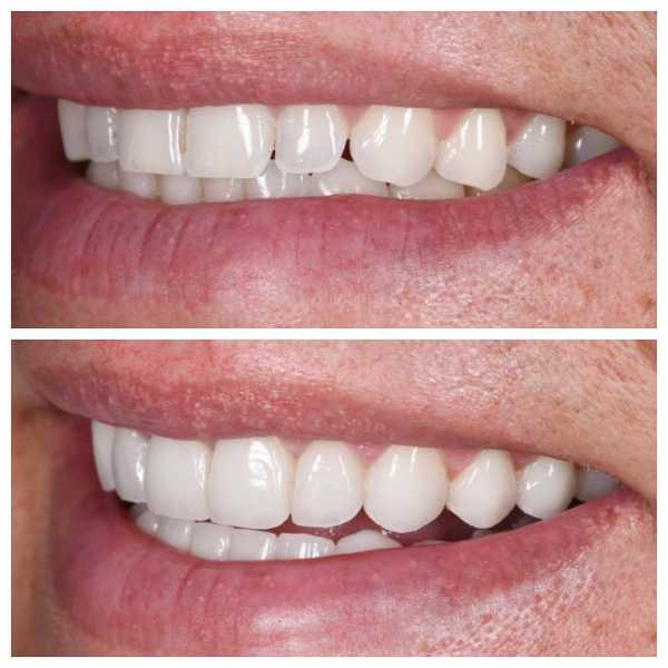 Smile Gallery Before and After