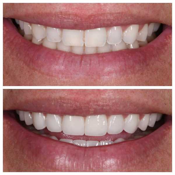 Smile Gallery Before and After