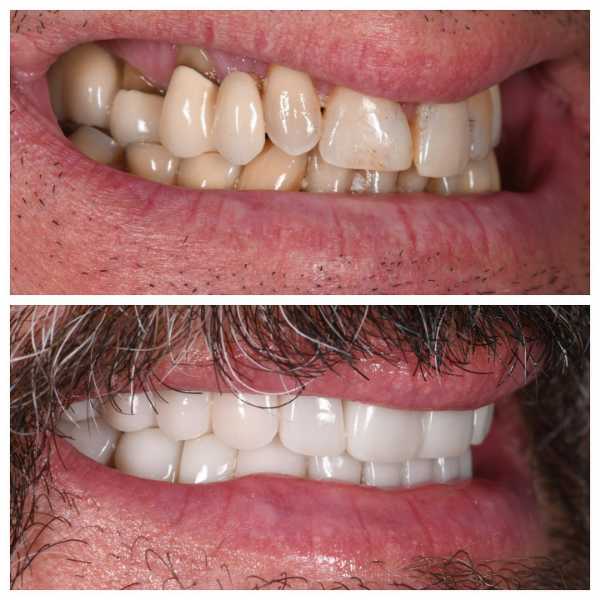 Smile Gallery Before and After