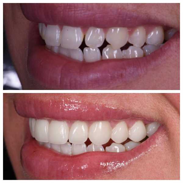 Smile Gallery Before and After
