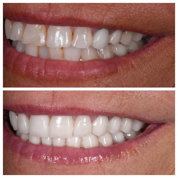Smile Gallery Before and After