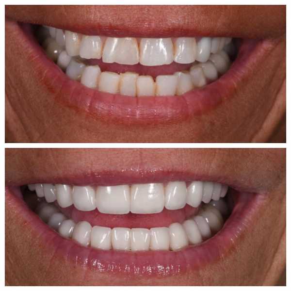 Smile Gallery Before and After