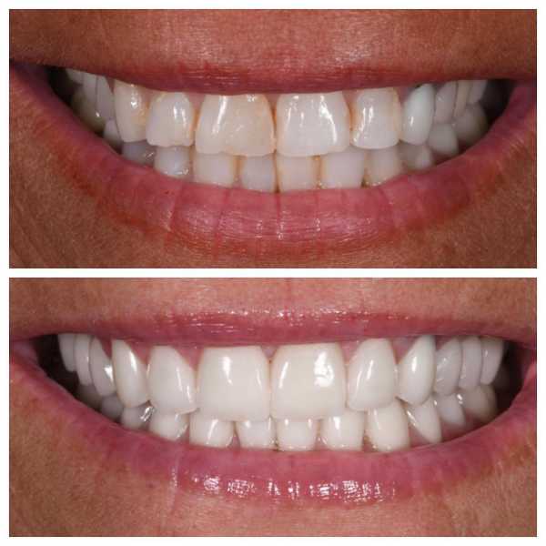 Smile Gallery Before and After