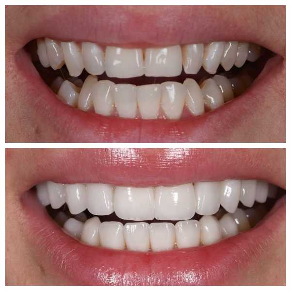 Smile Gallery Before and After