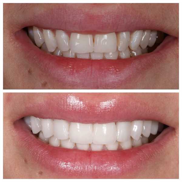 Smile Gallery Before and After