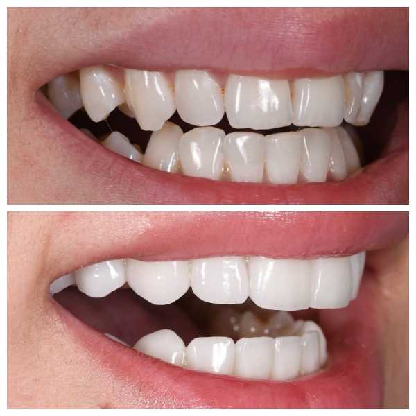 Smile Gallery Before and After
