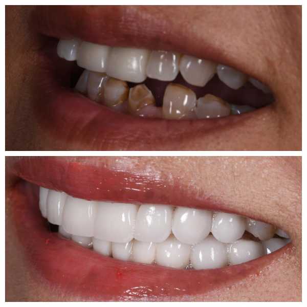 Smile Gallery Before and After