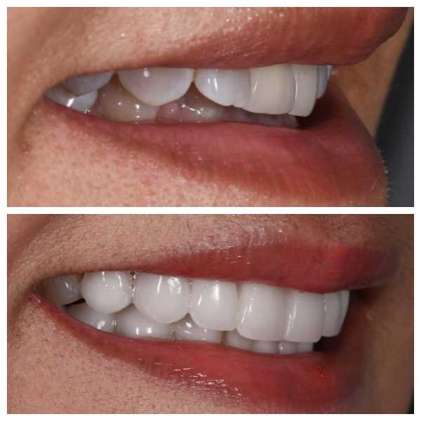 Smile Gallery Before and After