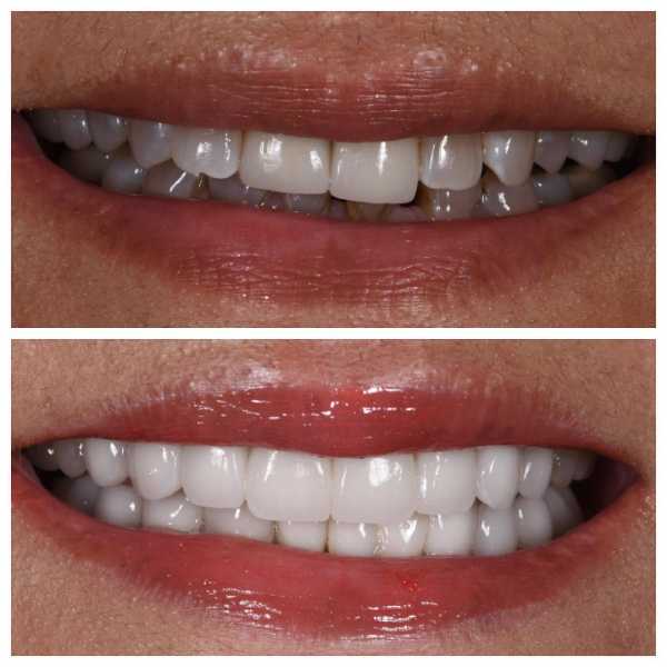 Smile Gallery Before and After