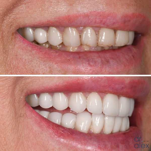 Smile Gallery Before and After