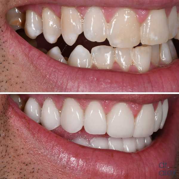 Smile Gallery Before and After