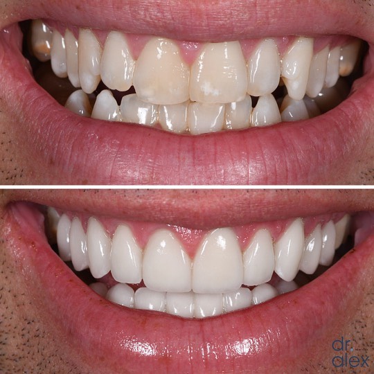 Smile Gallery Before and After