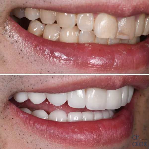 Smile Gallery Before and After