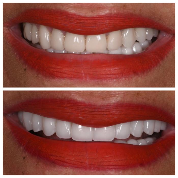 Smile Gallery Before and After