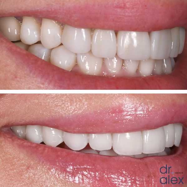 Smile Gallery Before and After