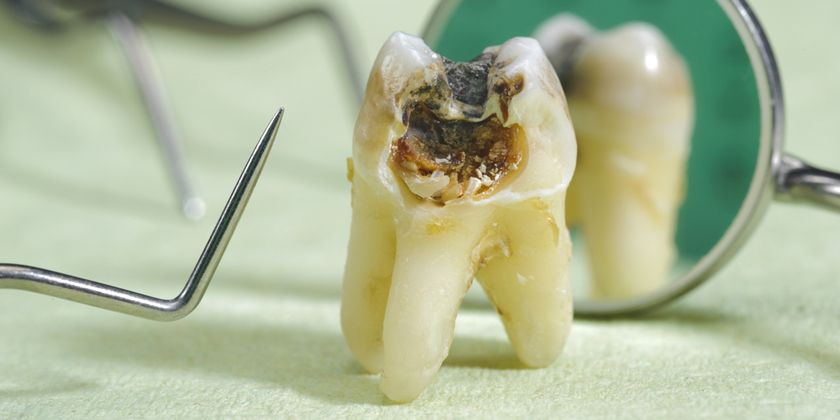 cavity prevention