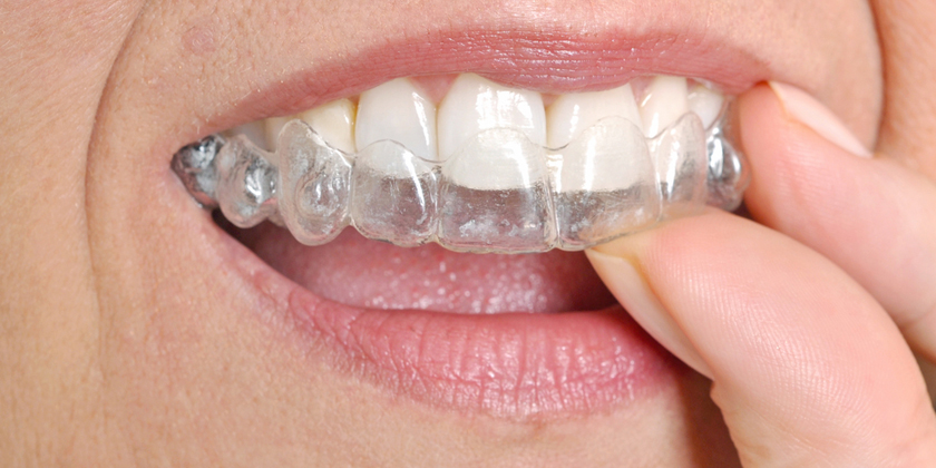 What Dental Conditions Can Invisalign Address?
