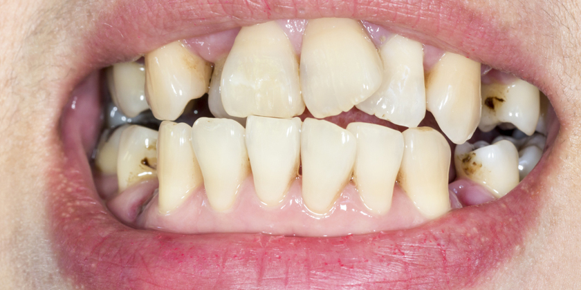 What’s The Best Solution for Crooked Teeth?