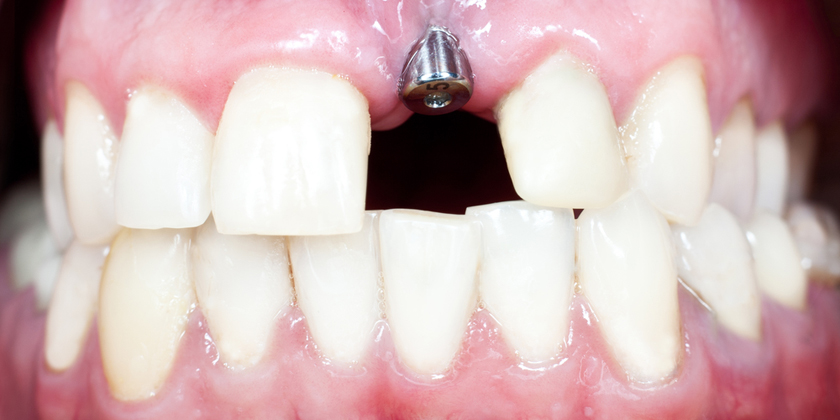 Understanding The Anatomy Of Dental Implants