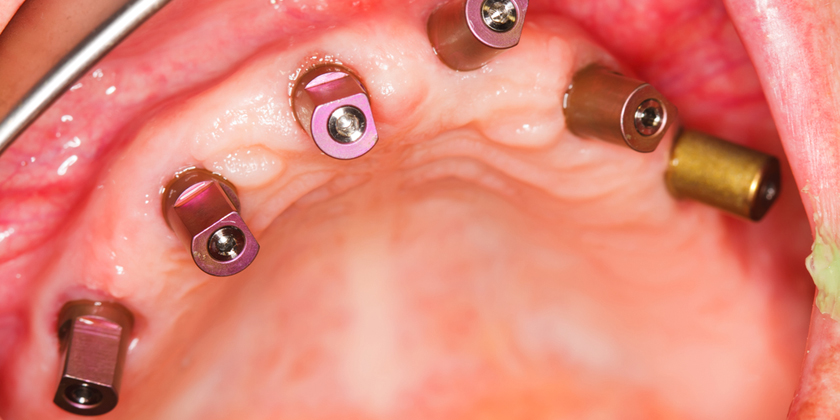 Why Are Dental Implants So Popular In NYC These Days?