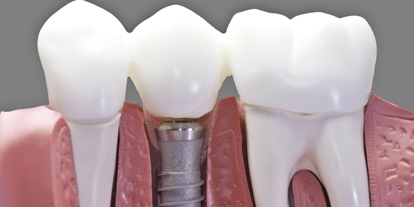 You Don’t Have To Be Scared Of Dental Implants in NYC!