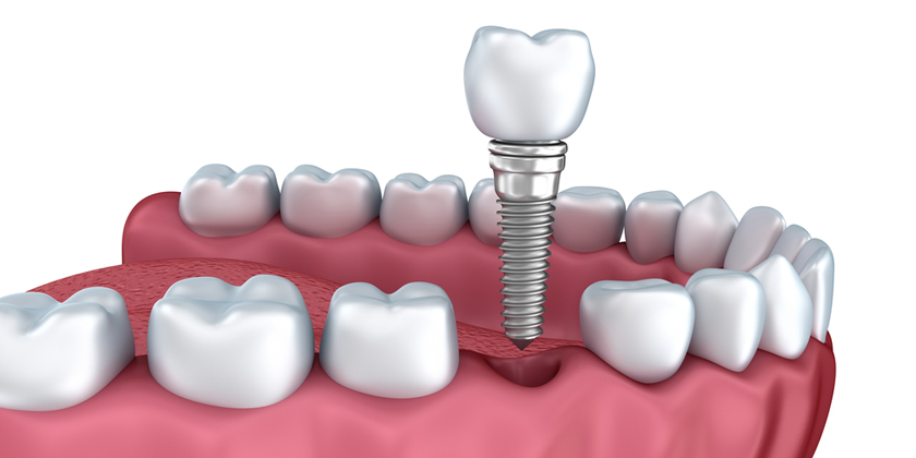 dental implants