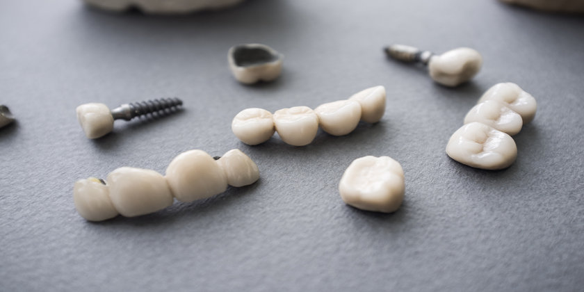 What’s The Difference Between Veneers And Crowns?
