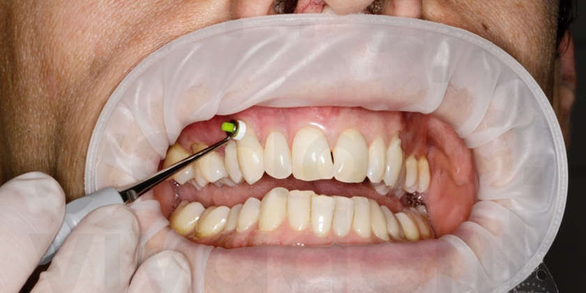 Why Optragate Is So Indispensable For Dentists