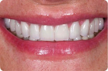 porcelain-veneers-befor-after-image-before