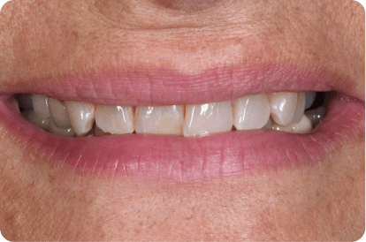 porcelain-veneers-befor-after-image-before-11