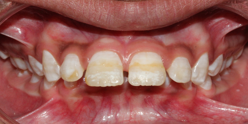 Prominent Teeth: Causes and Treatment
