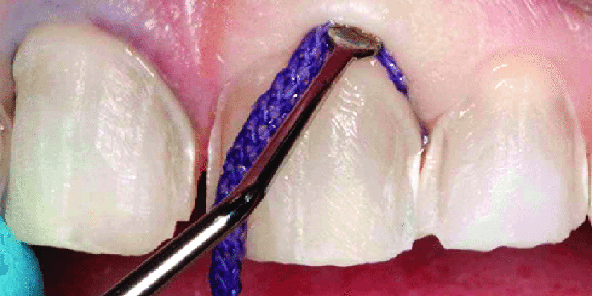 Why Retraction Cords Should Only Be Used Sparingly