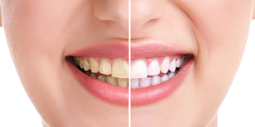 Teeth Whitening Results & Safety To Know
