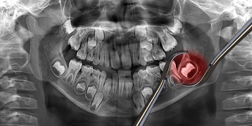 When Do You Need To Extract Your Wisdom Tooth?