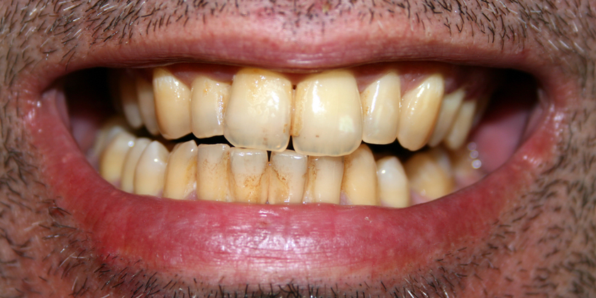 Eliminate Yellow Teeth with Teeth Whitening Today!